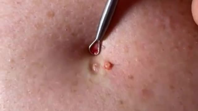 Blackhead Removal, Pimple popping, Acne Treatment #49