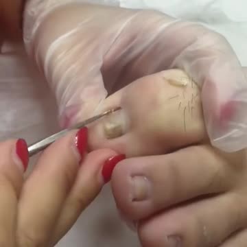 A BIG INGROWN TOENAIL