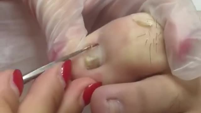 A BIG INGROWN TOENAIL