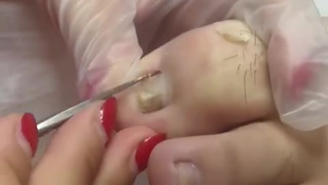 A BIG INGROWN TOENAIL