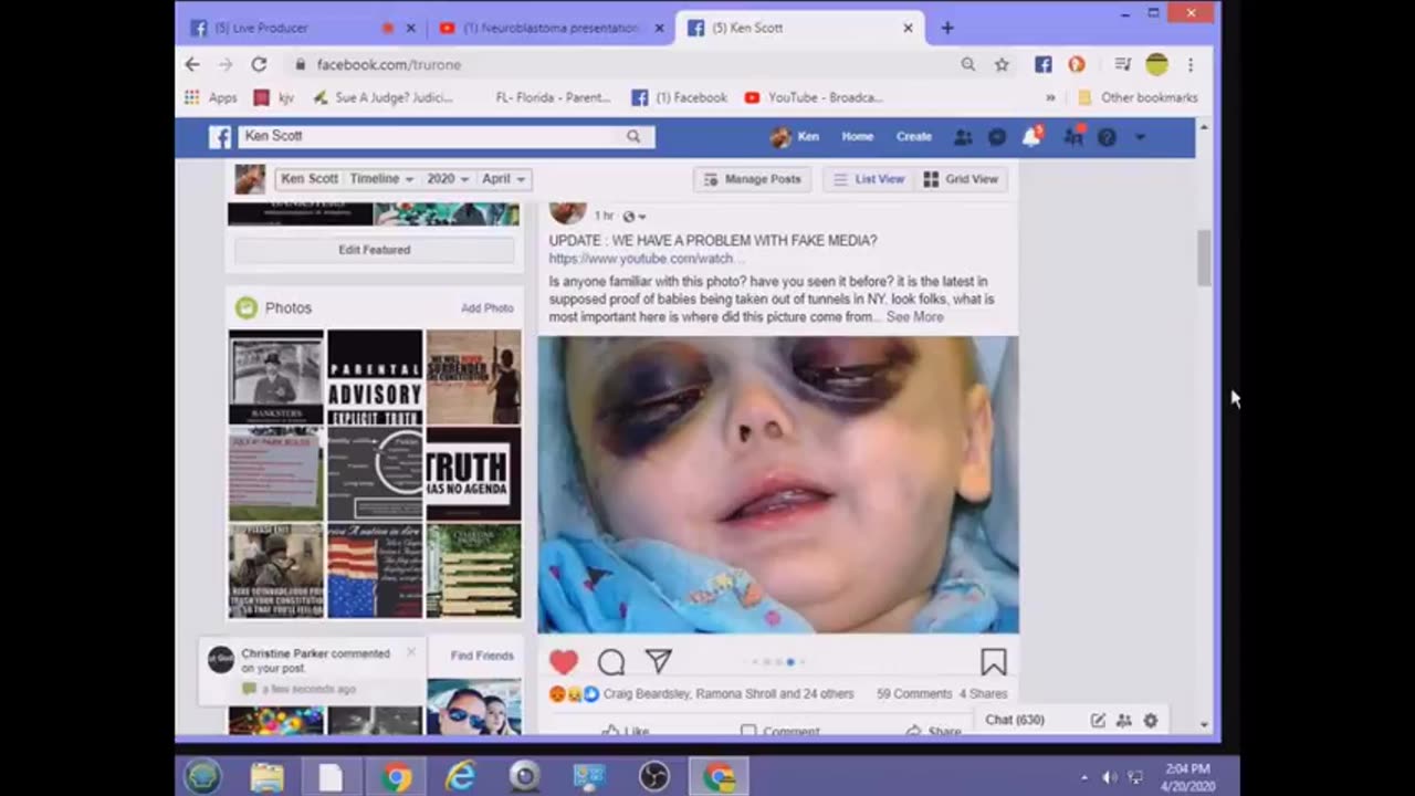 L⁰Ken Scott - Timothy Holmseth Panda Eyes Baby Pic Of Child After Brain Tumor