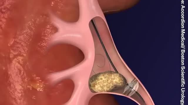 This is how doctors 👨⚕️ remove kidney stones