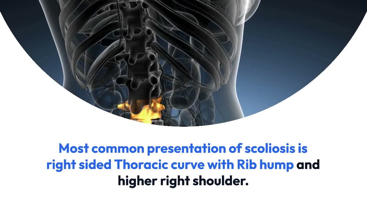 Adolescent Idiopathic Scoliosis – Selective Thoracic Fusion