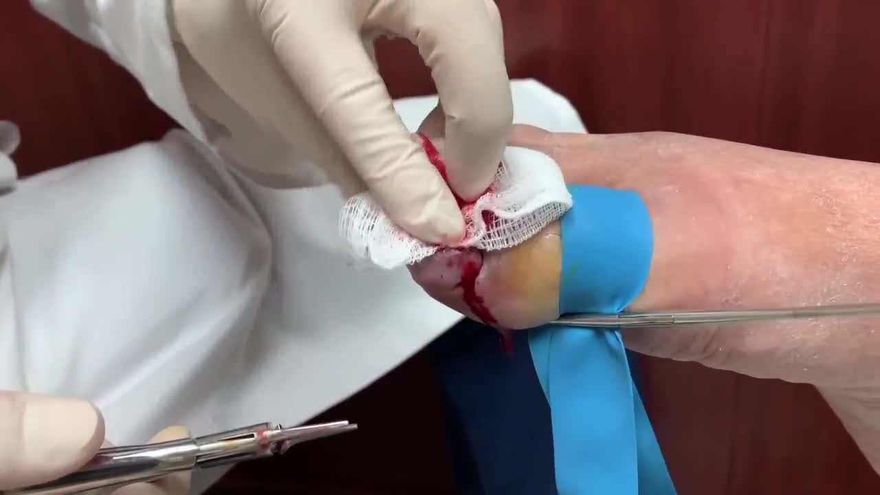 The Worst Ingrown Nail I’ve Seen