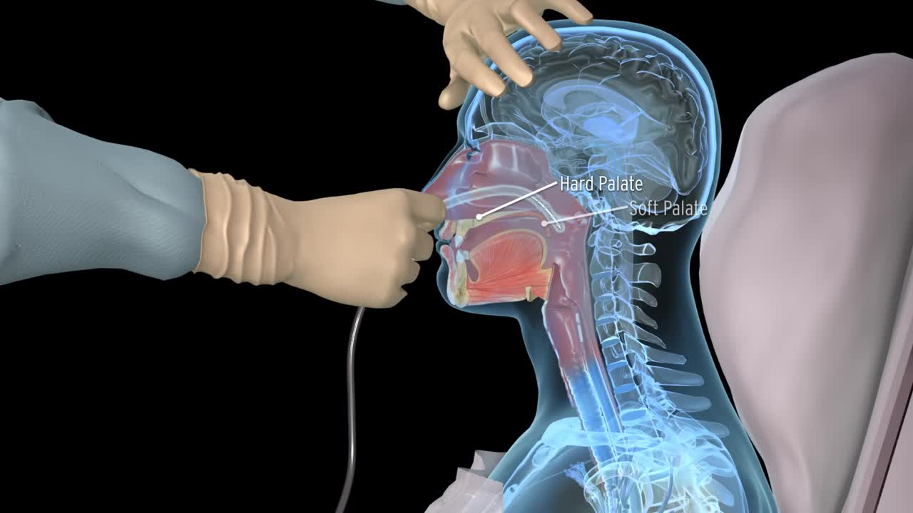 NG Intubation (Inserting a nasogastric tube) - 3D medical animation