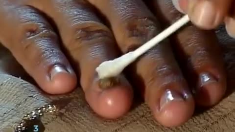 How to Cure Nail Fungus 