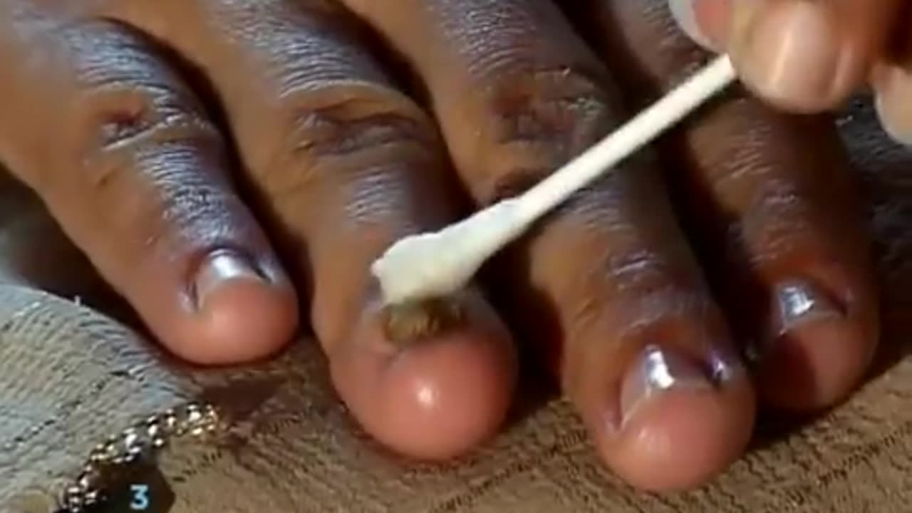 How to Cure Nail Fungus