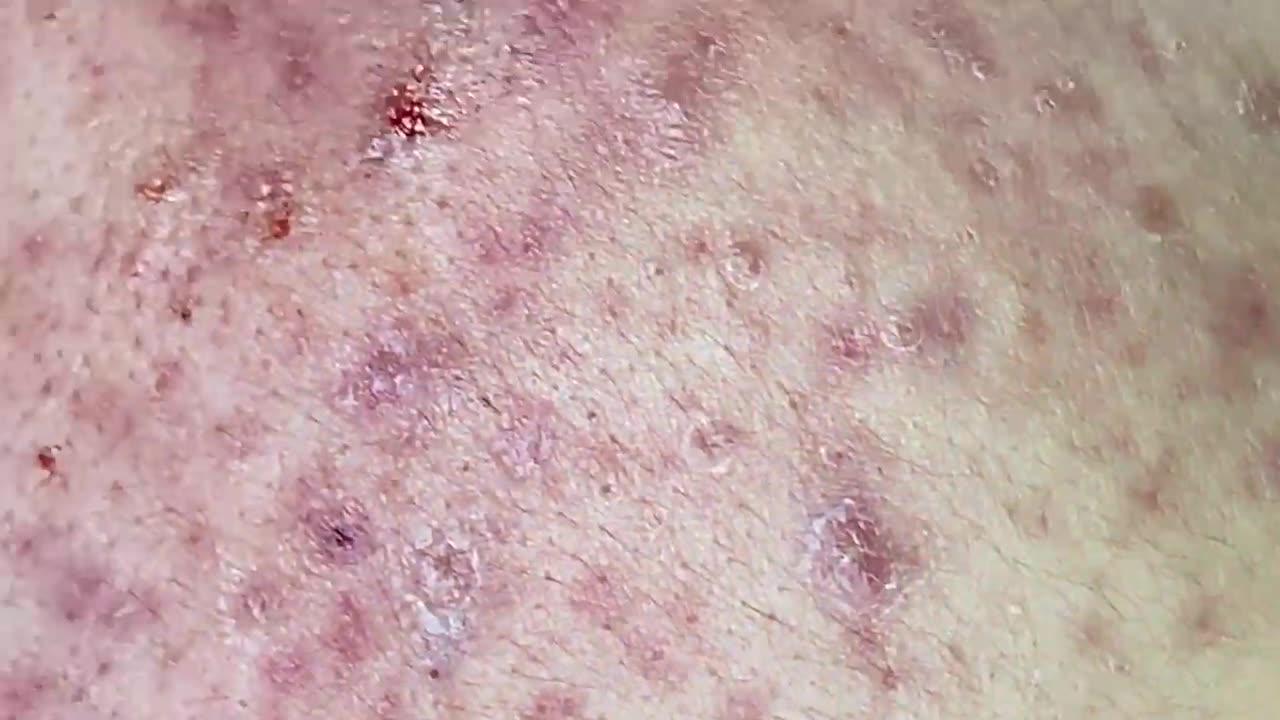 "Big Cystic Acne, Blackheads, and Milia Extraction Satisfying Pimple Popping and Whiteheads Removal"