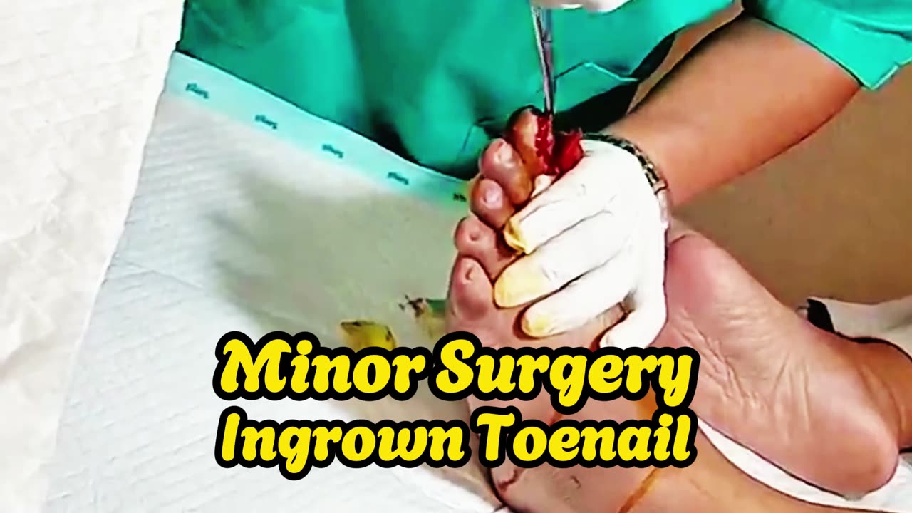 Say Goodbye to Pain: Effective Minor Surgery for Ingrown Toenails