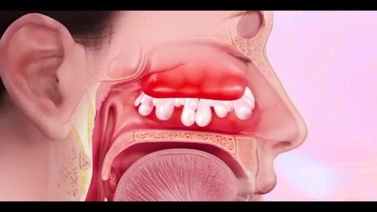 Nasal Polyps and their treatment | How Polypectomy is Performed? (Urdu/Hindi)