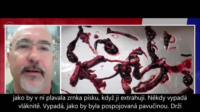 Bílé sraženiny v očkovaných mrtvolách