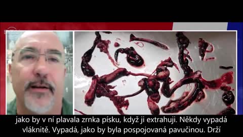 Bílé sraženiny v očkovaných mrtvolách
