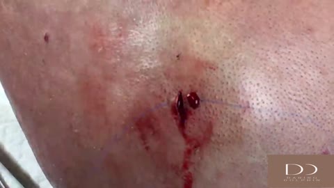 Back Cyst Removal