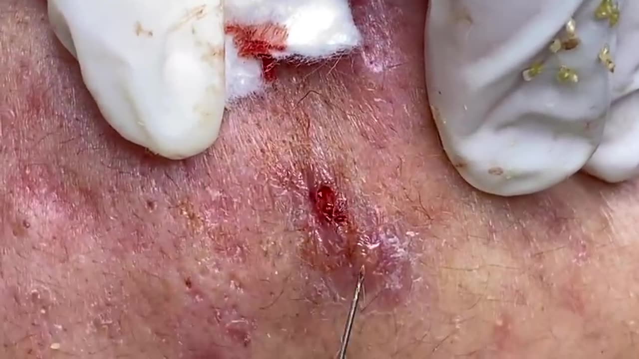 Big Cystic Acne Blackheads Extraction Blackheads & Milia, Whiteheads Removal Pimple Popping