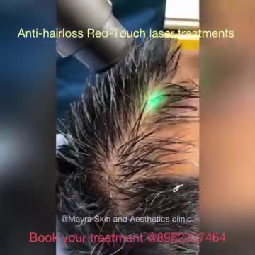 Revitalize Your Scalp: Anti Hair Loss Red Touch Laser Treatment at the Best Skin Clinic in Indore