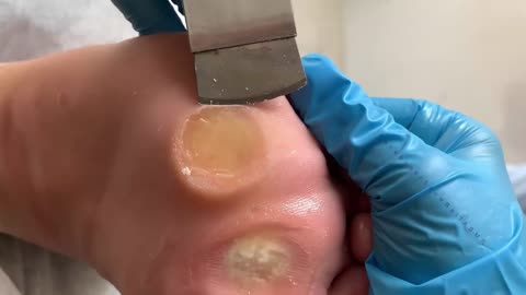 Wow! full version! Incredible plantar calluses like two eyes