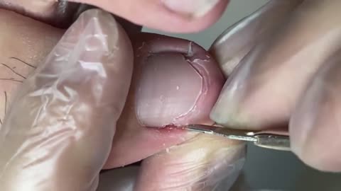 Satisfying ingrown toenail removal