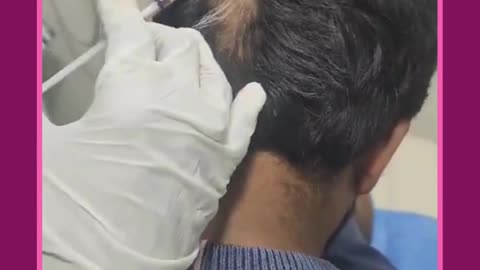 #Shorts - Treatment for Patchy Hair loss | Best Hair Clinic in Sarjapur Road | SK Truderma