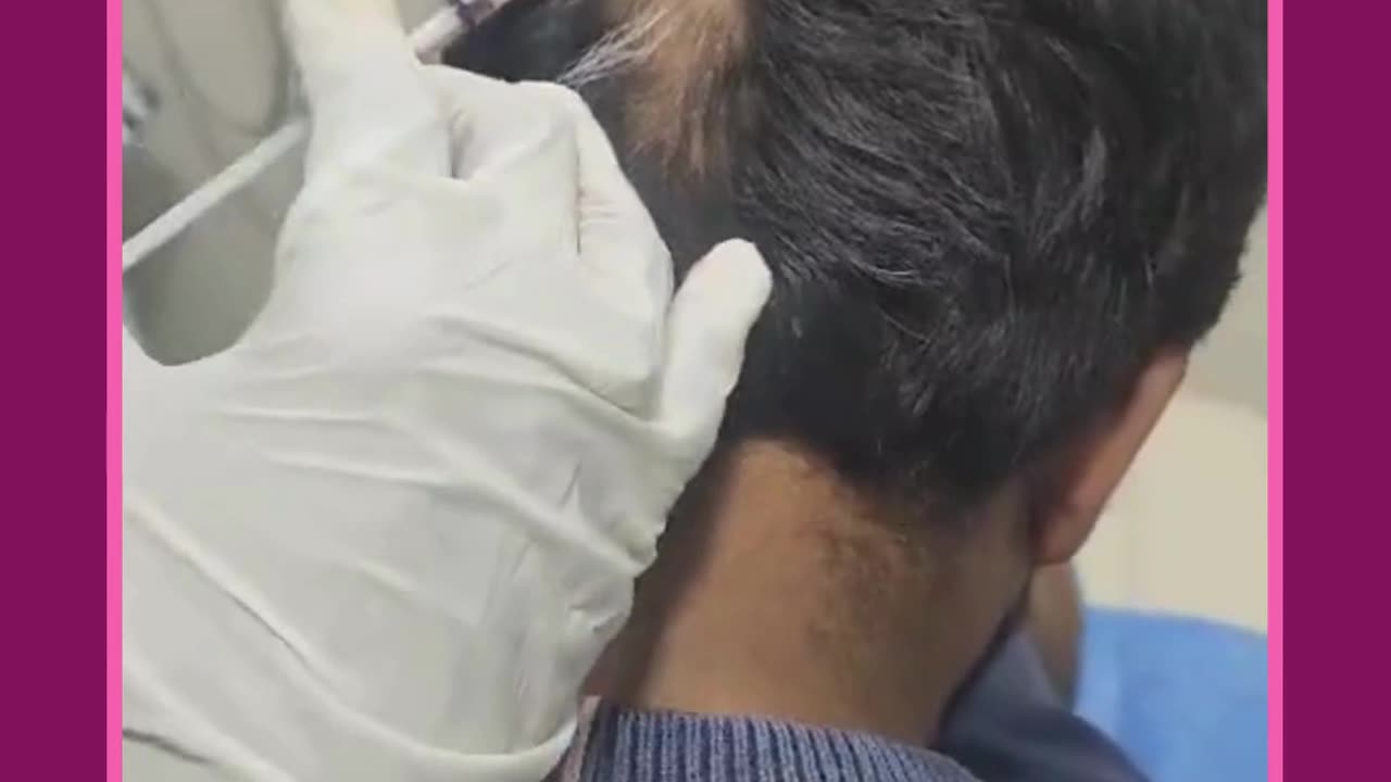 #Shorts - Treatment for Patchy Hair loss | Best Hair Clinic in Sarjapur Road | SK Truderma