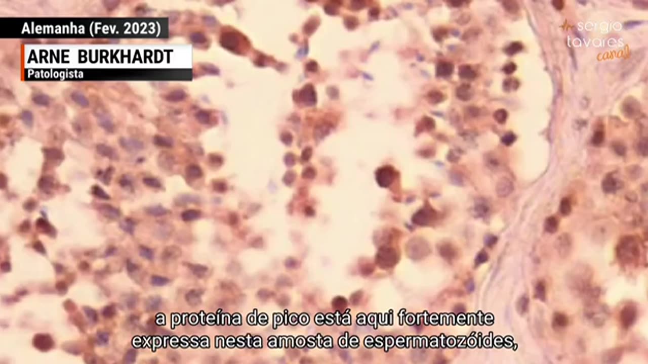 Arne Burkhardt, patologista, fala sobre os danos da vacina aos espermatozóides