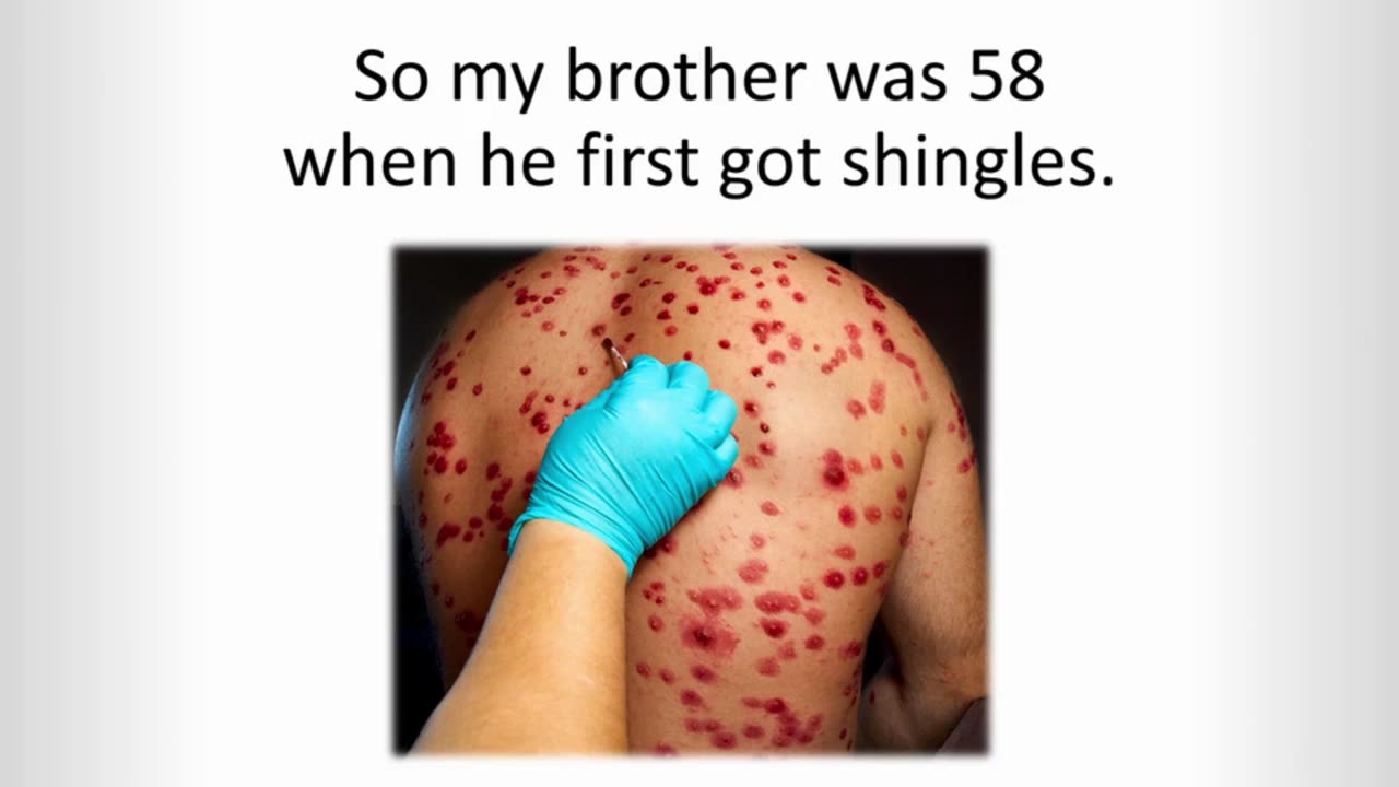 Got shingles? Do this now while you still can..