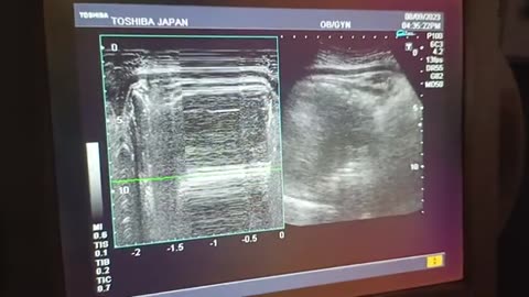 Female Gender at 37 Week with Thin Scar l Sixth baby l😌😌😌