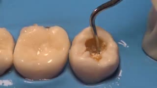 Cavity Restoration _Step by Step