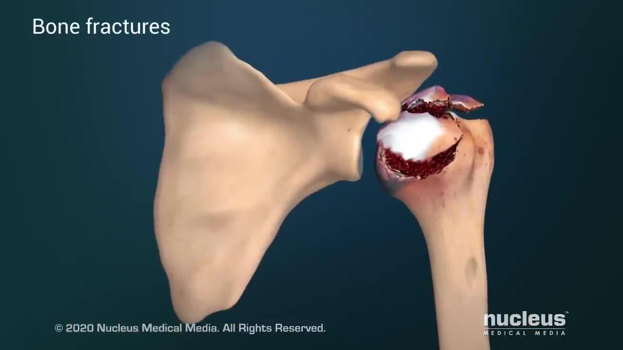 Total Shoulder Replacement