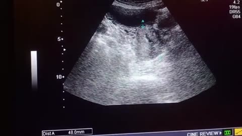 22 week pregnancy with suspicious mass abdomen