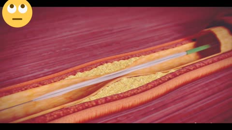 Coronary Artery Angioplasty ( Radial Access)