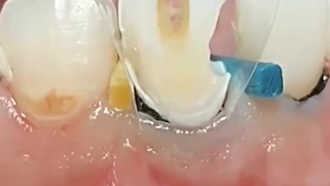 Class 1 cavity preparation / Rct