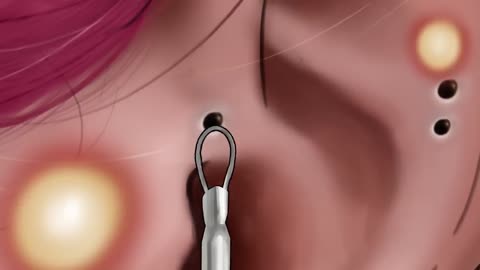 ASMR] Acne, Big Blackhead Removal Animation tinysom