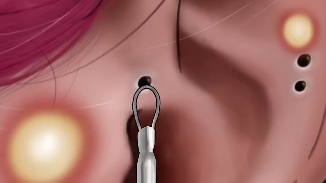 ASMR] Acne, Big Blackhead Removal Animation tinysom