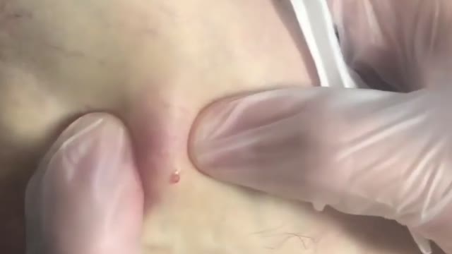 Giants Deep Blackheads, Whiteheads, Big Pimples, Hidden Acne Removal - Best Popping Videos #000025