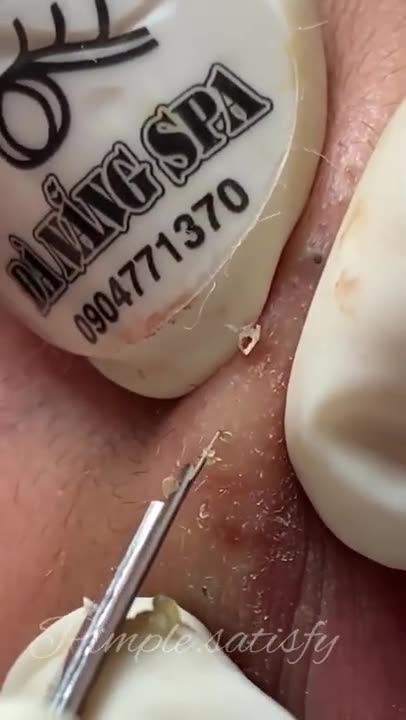 Cystic Acne Removal & Inflammatory Acne