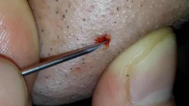 GIANT NEEDLE REMOVES INGROWN HAIR!!!!!!