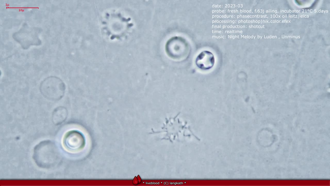 liveblood under a phasecontrast microscope. 5 days after incubator. Acanthocytes (Spur Cells)