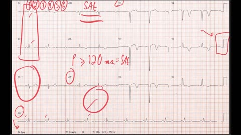 ECG - aneurisma de ventrículo esquerdo
