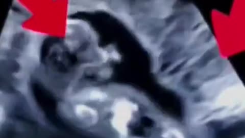 This Ultrasound Of A Baby STRUGGLING In AGONY To RESIST The PINCERS Of An ABORTIONIST