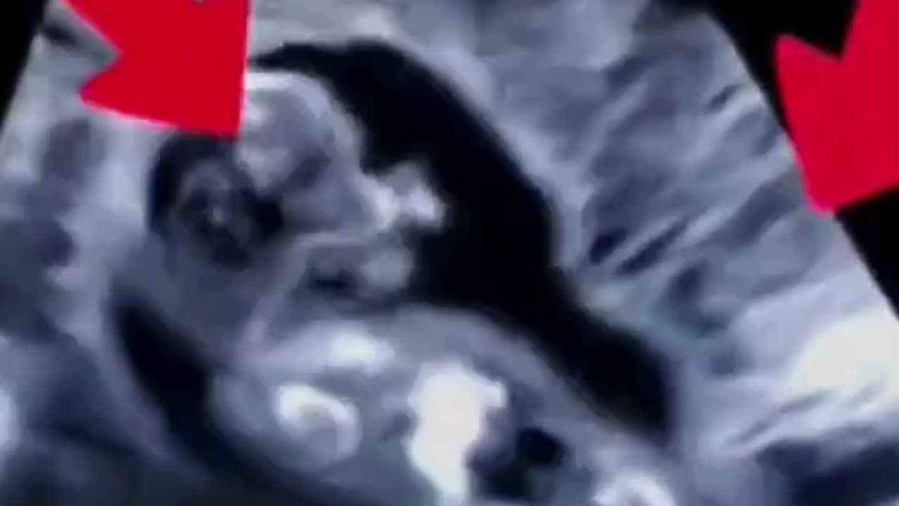 This Ultrasound Of A Baby STRUGGLING In AGONY To RESIST The PINCERS Of An ABORTIONIST