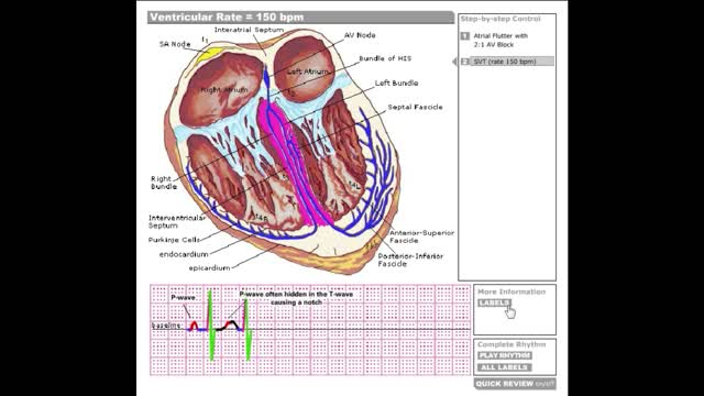 Dr Stanley's ECGcourse.com | Special Case Ventricular Rate = 150 bpm Tutorial