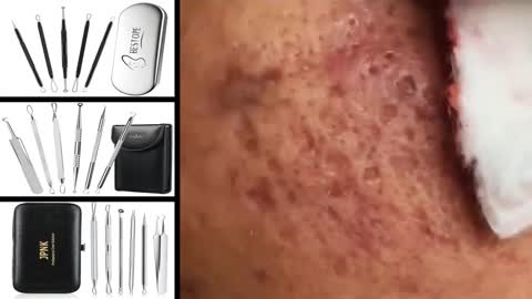 Blackheads Removal & Pimple Popping Videos 2022 #01