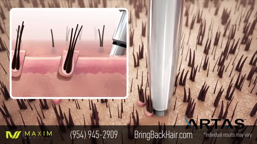 New technology of Robotic Hair Transplantion