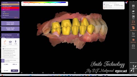 #design #naildesign #dental #dentaldesign #exocadexpert