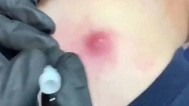 Blackhead & Juicy Cyst