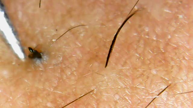 Removing the horrible Ingrown Hair root