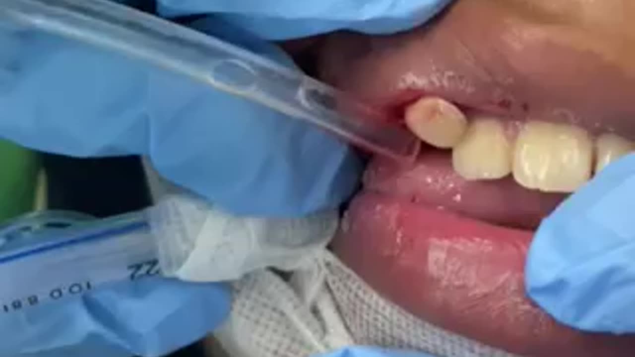 Tooth Extraction