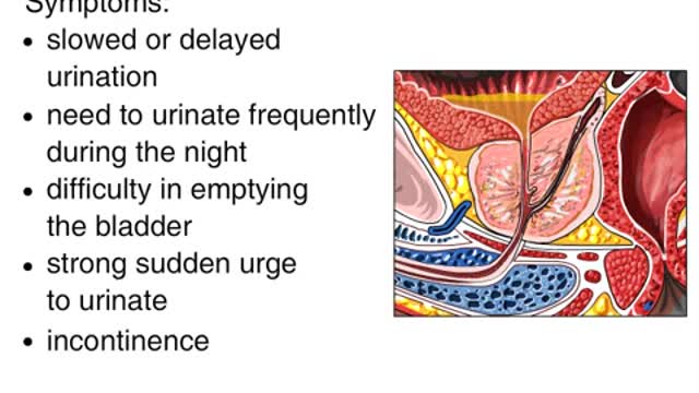 Prostate Problem Symptoms - 1 In 3 Men Who Lack This Prostate Nutrient Risk Total Kidney Shutdown