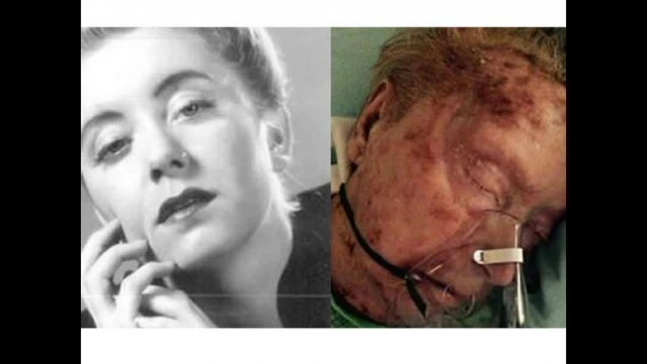 Former model eaten alive by scabies in Georgia nursing home