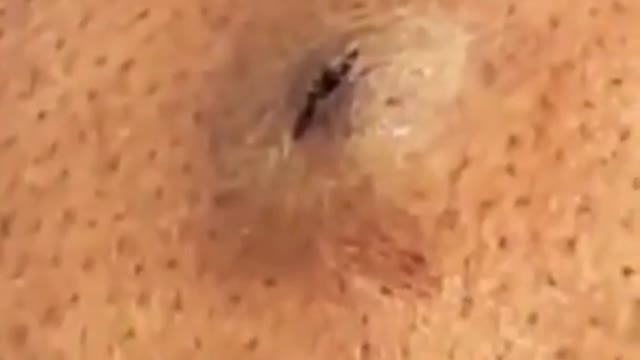 Blackhead Removal - Pimple popping - Acne Treatment - 31 #shorts